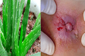 Aloe fir d'Behandlung vun Hämorrhoiden