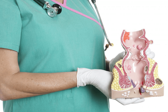 Den Dokter weist den hemorrhoid Modell bewisen