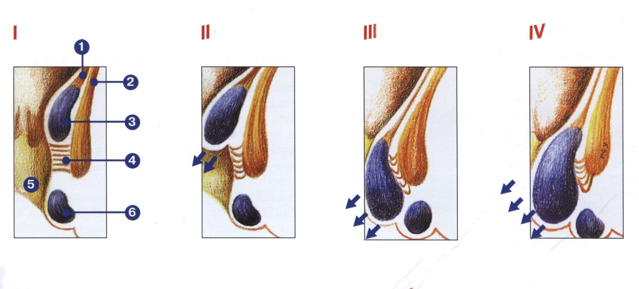 Etappe vun hemorrhoid Entwécklung