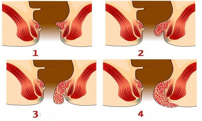 wéi Hämorrhoiden a verschiddene Stadien ausgesinn